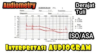 Audiometry dan Interpretasi Audiogram Tuli konduktif sensorineural, campuran ringan sedang berat