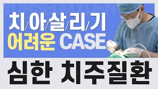 case #2. 심한 치주질환 동반! 흔들리고 잇몸고름 심할땐  인접치에 위해서라도 빨리 발치후 임플란트로 go~! #남은치아 잇몸  관리하는방법