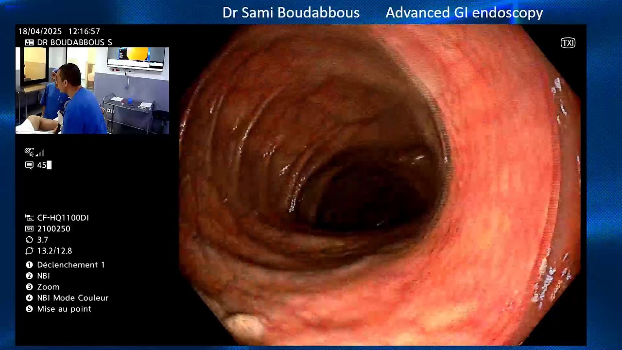 Screening Endoscopy Youtube