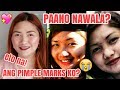 HOW TO REMOVE DARKS SPOTS AND ACNE/PIMPLE MARKS| Kristel Fai