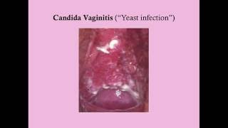 Infectious Vaginitis CRASH Medical Review Series