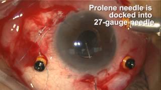 Transscleral Fixation of Dislocated Intraocular Lens (IOL)