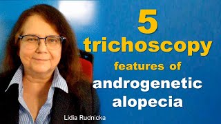 The 5 trichoscopy features of androgenetic alopecia