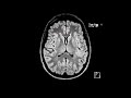 ms white matter lesions first look mri