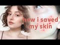 how i saved my skin from adult acne (+current skin care routine) || epiduo review & side effects