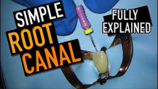 SIMPLE ROOT CANAL FULLY EXPLAINED | I ❤️ THE PULP