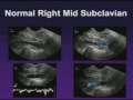 Upper Extremity Venous Exam Technique and Interpretation