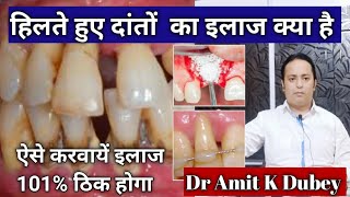 हिलते हुए दांतों का इलाज कैसे करते हैं [ Best home remedies for gum recession hindi]