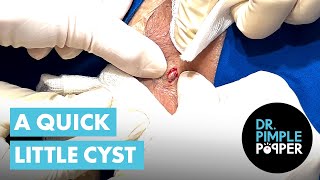 A Quick Little Cyst