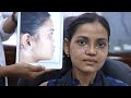 Face Change Results After Nose Job Plastic Surgery in India | Before & After Results