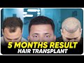 Hair Transplant in Lucknow | Best Results & Cost of Hair Transplant in Lucknow