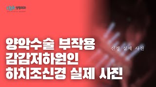 [닥터봉TV_CBK성형외과_최봉균] 양악수술 부작용 감감저하원인 하치조신경 실제 사진 - 신경손상 예방법[CBK整形外科チェボンギュン] 両顎手術の副作用 感覚低下原因 - 神経損傷予防法