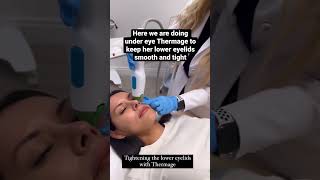 Tightening lower lids #thermage #antiaging #over40 #over50