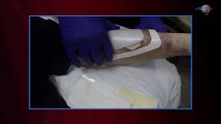 WCW: Treating a Forearm Wound with Prisma and OxyBand