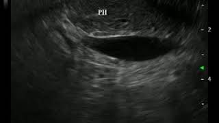 Video 19 Scanning Ampulla and Papilla from Duodenum