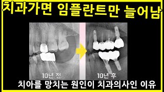 치과가면 임플란트만 늘어남. 치과의사 잘못인 이유. Crown Lifespan. 크라운수명연장법.