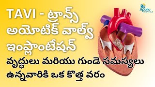 TAVI - ట్రాన్స్ అయోటిక్ వాల్వ్ ఇంప్లాంటేషన్ వృద్ధులు మరియు గుండె సమస్యలు ఉన్నవారికి ఒక కొత్త వరం