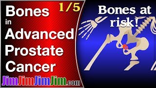 Advanced prostate cancer: Bones at risk!