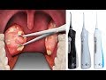 Remove Tonsil Stones Without Surgery with 4 Easy Ways Remove Tonsil Stones Without Surgery with 4 Easy Ways