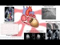 Octopus pot cardiomyopathy//#takotsubocardiomyopathy #shorts #ytshorts