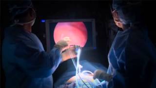 First Single-Incision Robotic Cholecystectomy in Boston
