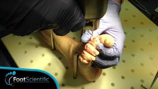 Lab Demo FuseRight Hammer Toe Surgical Correction