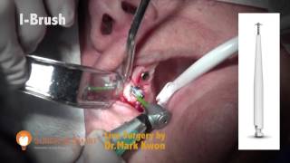 Live Surgery by using R-brush and I-brush