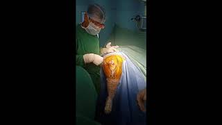 Microplasty - Oxford knee