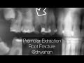 Premolar Extraction with Fractured Root