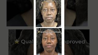 SCULPTRA FACELIFT - Incredible Results without Surgery! #sculptra