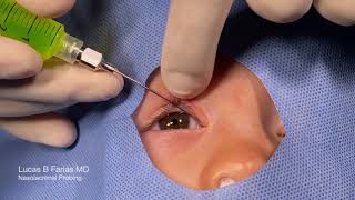 Probing of Nasolacrimal Duct with Fluorescein Irrigation