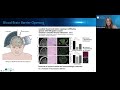 focused ultrasound for glioblastoma