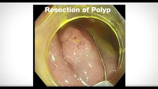 COINTIP™ Snare - Cold Endoscopic Mucosal Resection - Dr. Bhandari UEGW 2020