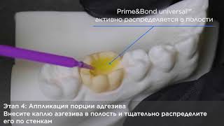 Prime\u0026Bond universal: адгезивный протокол в технике селективного протравливания