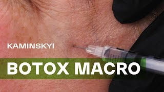 ИНЪЕКЦИИ БОТОКСА. МАКРОСЪЕМКА | BOTOX INJECTIONS. MACRO ★ EDGAR KAMINSKYI