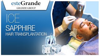 esteGrande Hair Transplant Journey - Ice Sapphire Micro FUE Part 2