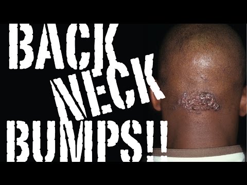 BACK NECK BUMPS/KELOIDS: the Cause & the CURE! Part One BACK NECK BUMPS/KELOIDS: the Cause & the CURE! Part One