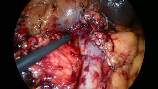 Total Laparoscopic Whipple Procedure with Pancreaticogastrostomy