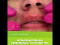 curso intradermoterapia presurizada hyaluron pen