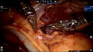 Robotic Resection of Medisatinal Parathyroid Adenoma