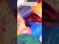 step by step exploratory laparotomy for bowel obstruction hernia meded surgerysteps surgskills