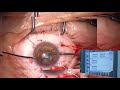 membranous cataract in pkp eye ...deemed as impossible phaco lukan mishev live stream