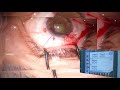 membranous cataract in pkp eye ...deemed as impossible phaco lukan mishev live stream