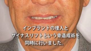 骨が極端に薄かったためにインプラント手術と同時に骨造成を行ったの治療例動画（60代男性）