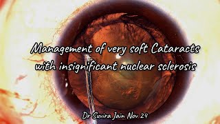 The Best way to manage a Soft Cataract  - with insignificant nuclear sclerosis.