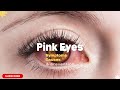 Pink Eyes Symptoms, Causes, Prevention & Treatment |Eye infection |Conjunctivitis Epidemic |Eye Flu