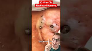 Crazy 10 Year Old BLACKHEADS REMOVAL #shorts