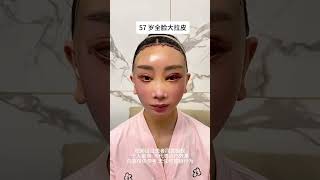 57岁全脸大拉拉#整形 #医美 #facelift #plastic #大拉皮 #拉皮