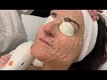 ipl luz pulsada intensa . rejuvenecimiento facial y de escote