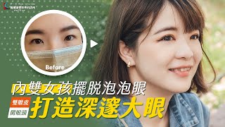 擺脫雙眼皮貼！內雙眼妝困擾！｜割雙眼皮｜開眼頭手術｜雙眼皮手術｜手術案例｜周爾康整形外科 ft.林永祥醫師